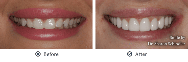 What makes Lumineers the most requested dental veneers by dentists and patients?
