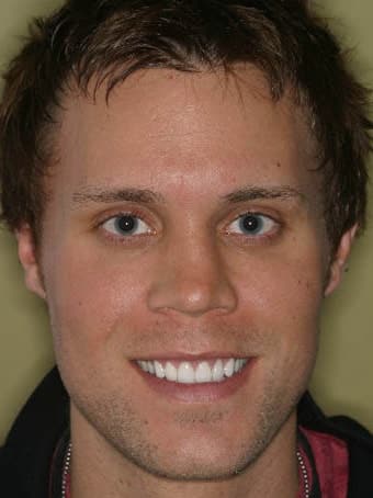 Real Columbus Ohio Cosmetic Dental Patient - Andy After Treatment