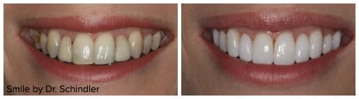 Before and after photo of metal-free bridges from Dr. Sharon Schindler