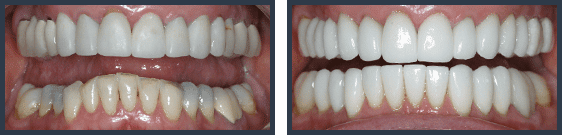 Full mouth rejuvenation case by Dr. Sharon Schindler