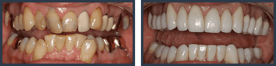 A full mouth rejuvenation case by Dr. Sharon Schindler