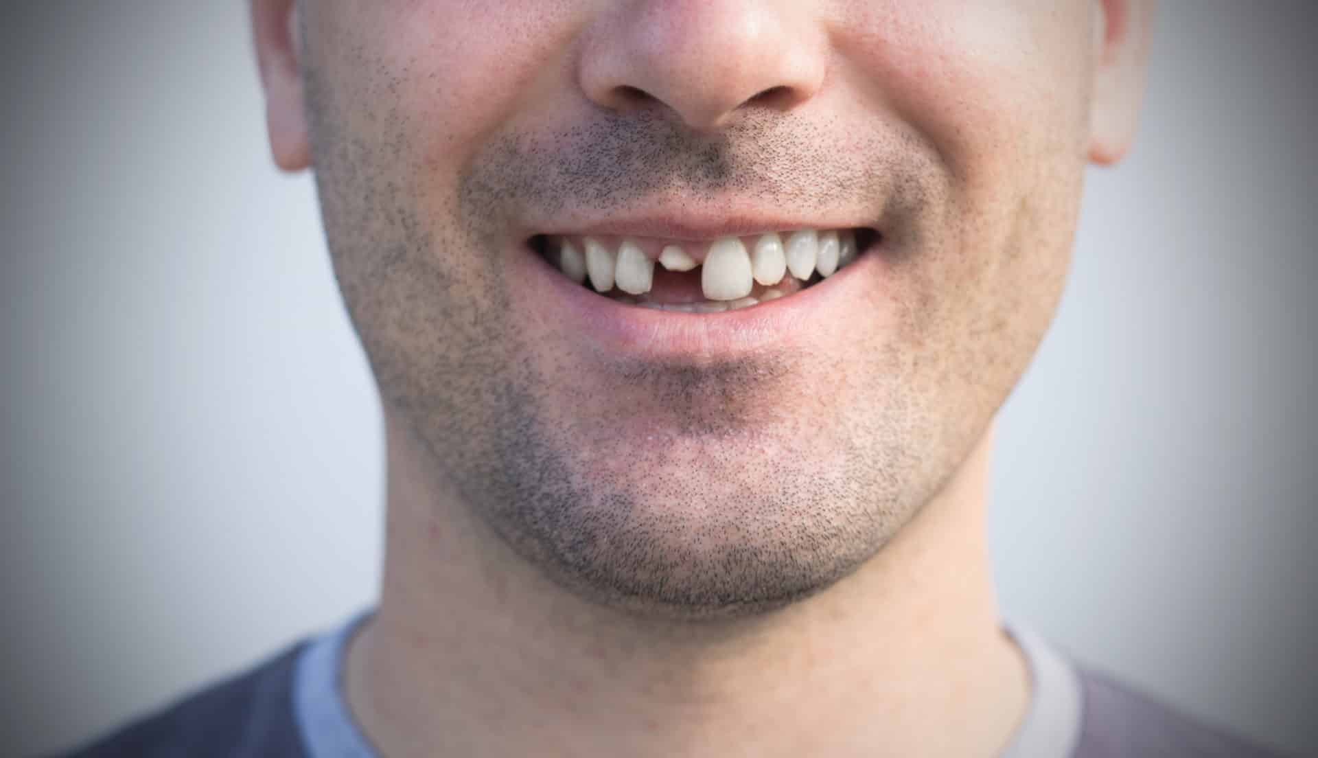 Male broken teeth damaged cracked front tooth needs a dental implant.