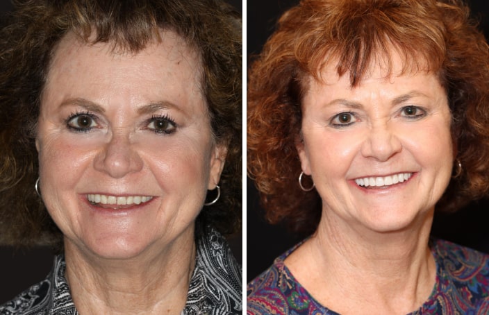 Collage of before and after cosmetic dental treatment photo