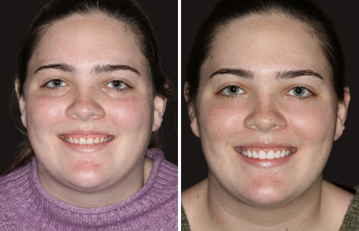 Collage of before and after cosmetic dental treatment photo