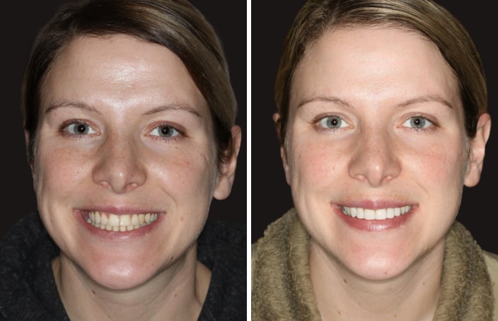 Collage of before and after cosmetic dental treatment photo