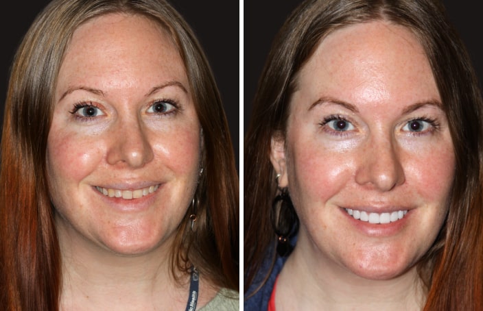Collage of before and after cosmetic dental treatment photo