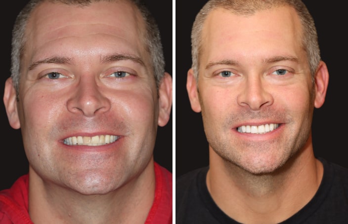 Collage of before and after cosmetic dental treatment photo