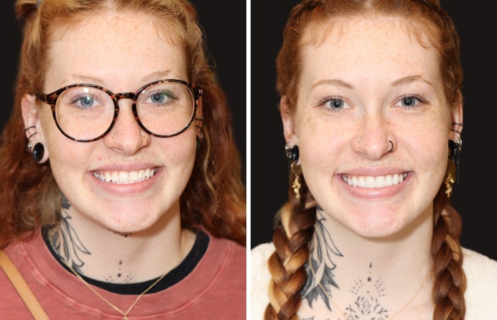 Collage of before and after cosmetic dental treatment photo