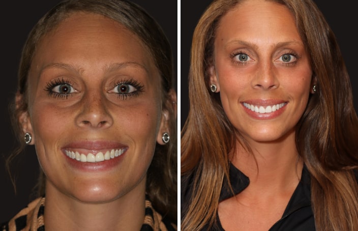 Collage of before and after cosmetic dental treatment photo