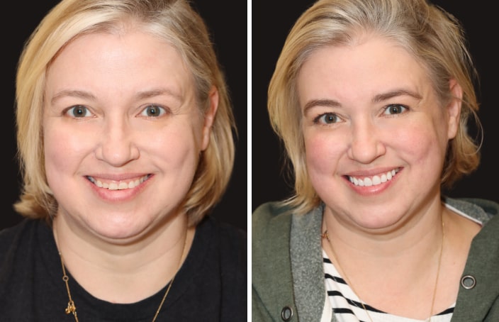 Collage of before and after cosmetic dental treatment photo