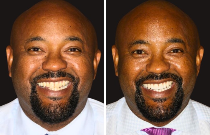 Collage of before and after cosmetic dental treatment photo