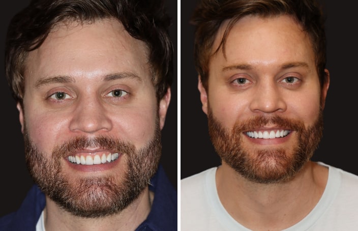 Collage of before and after cosmetic dental treatment photo