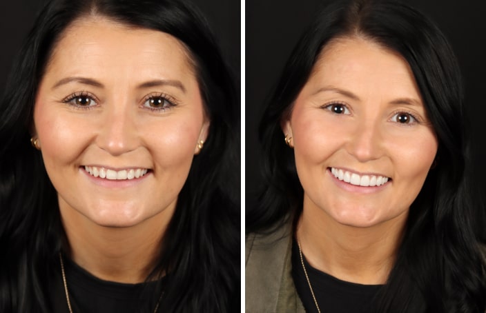 Collage of before and after cosmetic dental treatment photo