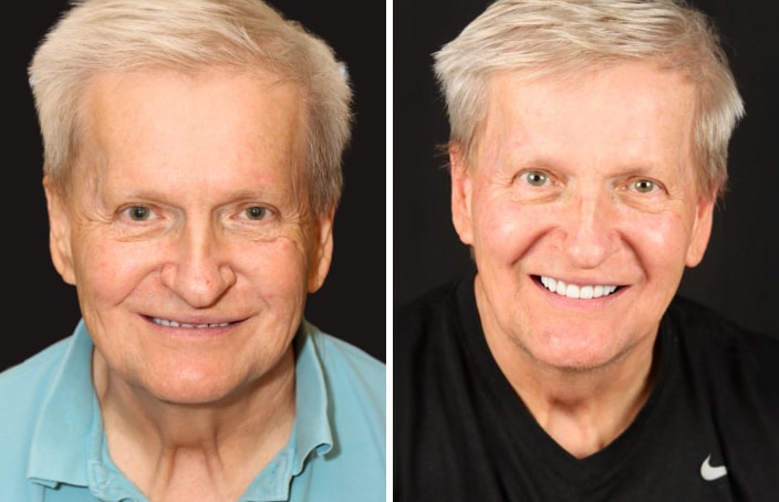 Collage of before and after cosmetic dental treatment photo