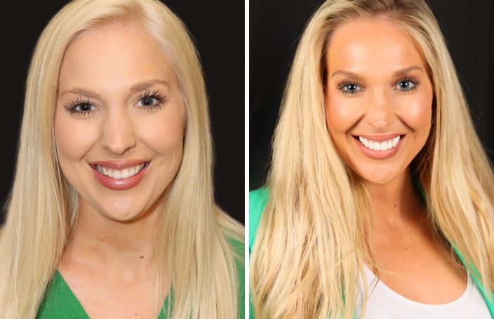 Collage of before and after cosmetic dental treatment photo