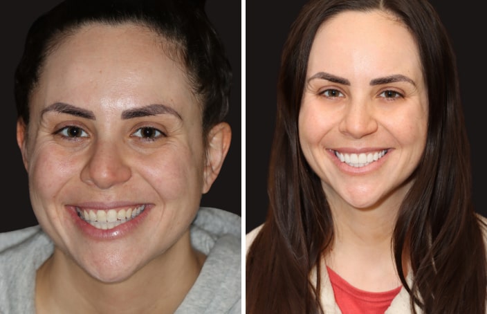 Collage of before and after cosmetic dental treatment photo