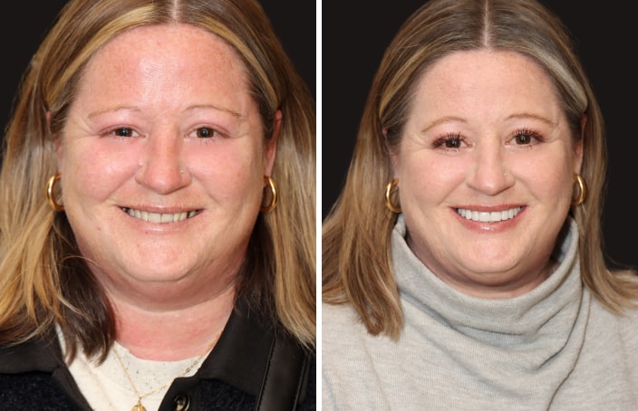 Collage of before and after cosmetic dental treatment photo