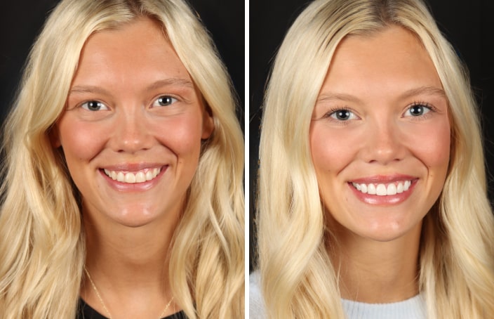 Collage of before and after cosmetic dental treatment photo