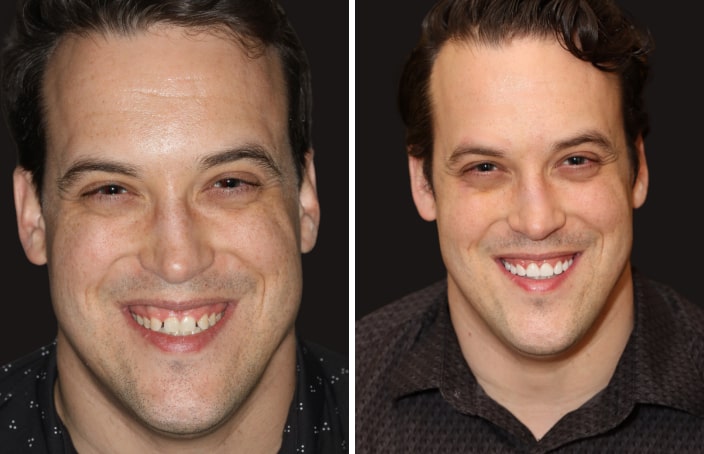 Collage of before and after cosmetic dental treatment photo