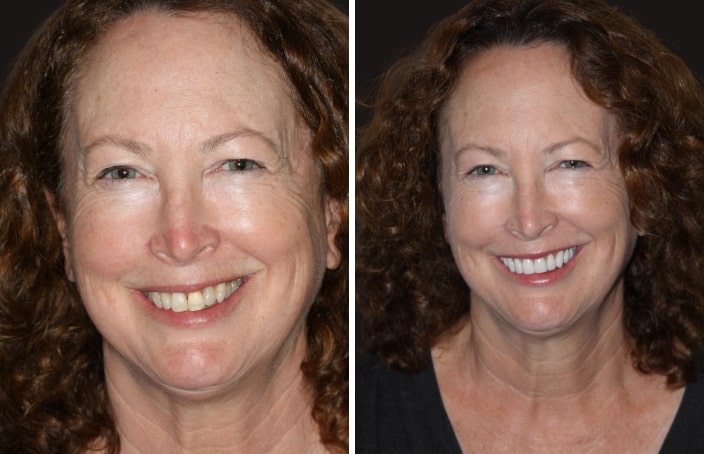 Collage of before and after cosmetic dental treatment photo