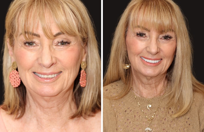 Collage of before and after cosmetic dental treatment photo