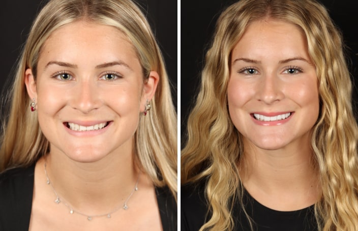 Collage of before and after cosmetic dental treatment photo