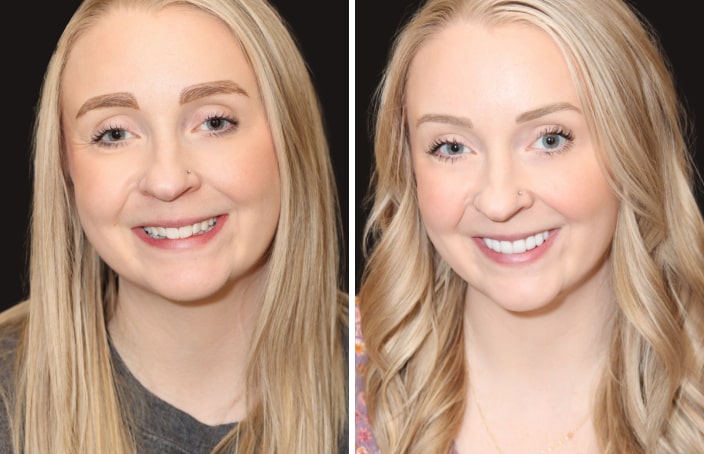 Collage of before and after cosmetic dental treatment photo