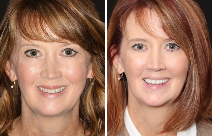 Collage of before and after cosmetic dental treatment photo