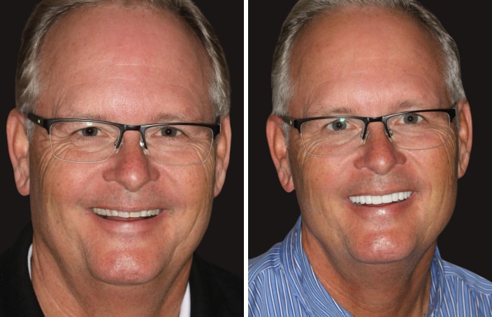Collage of before and after cosmetic dental treatment photo