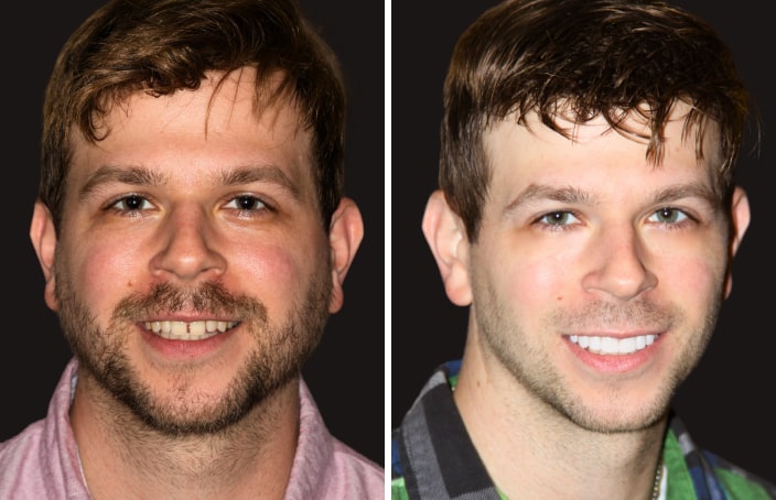 Collage of before and after cosmetic dental treatment photo