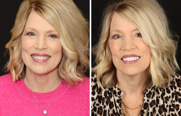 Collage of before and after cosmetic dental treatment photo