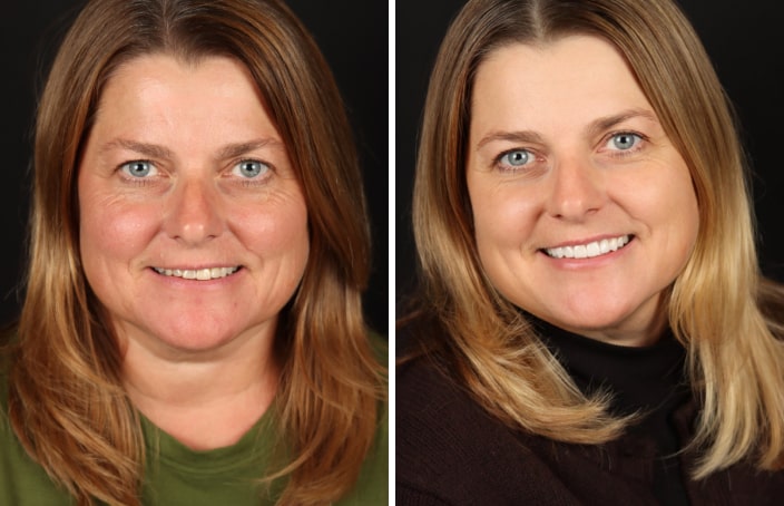 Collage of before and after cosmetic dental treatment photo