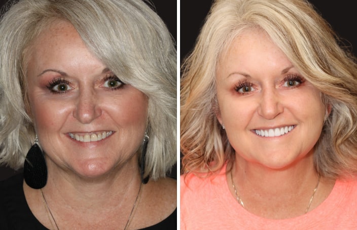 Collage of before and after cosmetic dental treatment photo