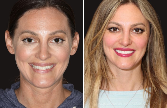 Collage of before and after cosmetic dental treatment photo