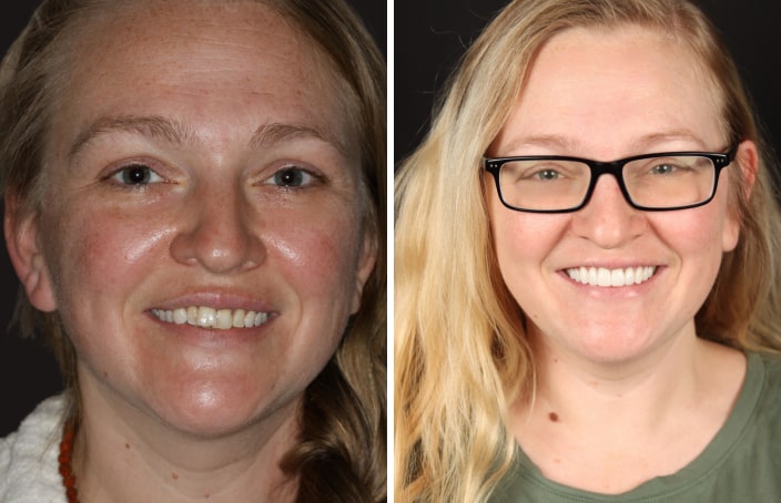 Collage of before and after cosmetic dental treatment photo