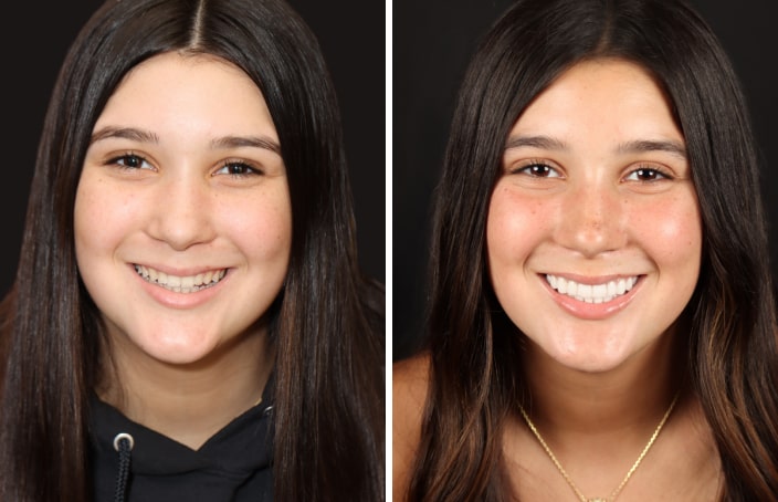 Collage of before and after cosmetic dental treatment photo