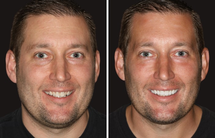 Collage of before and after cosmetic dental treatment photo