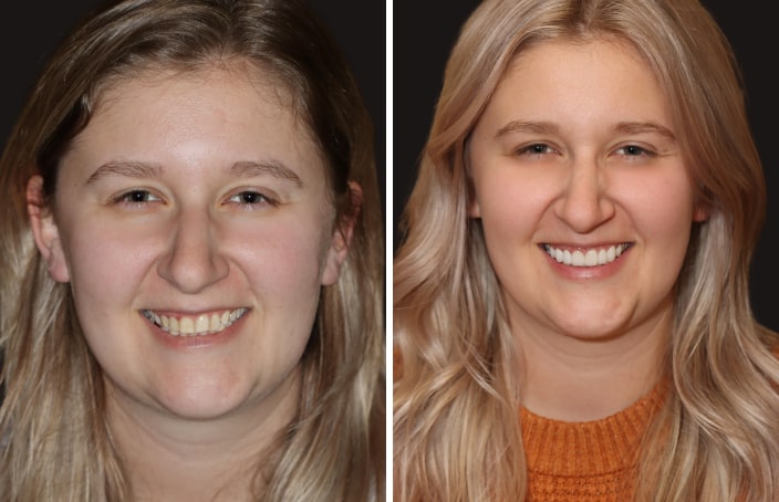 Collage of before and after cosmetic dental treatment photo