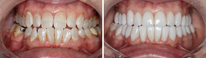 Smile of our patient