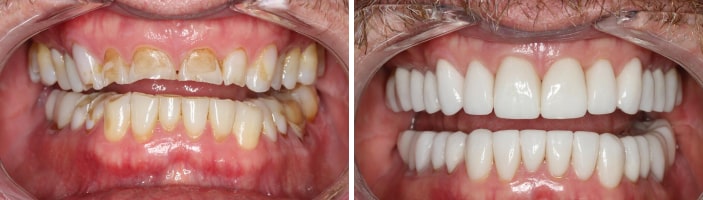 Smile of our patient