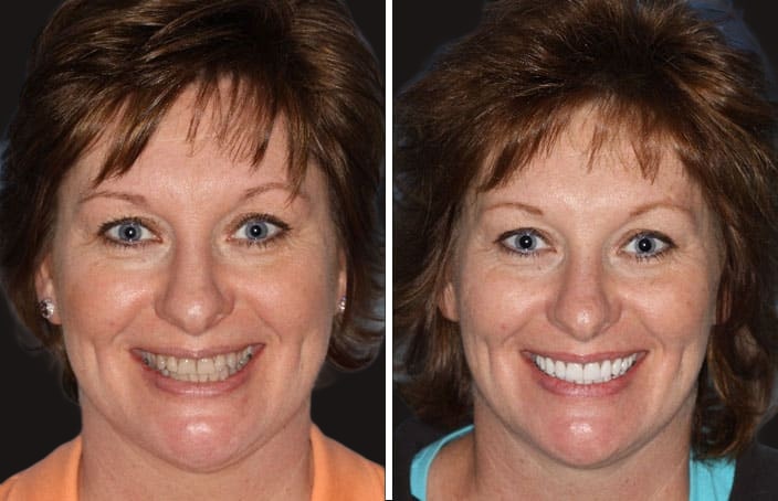 Collage of before and after cosmetic dental treatment photo