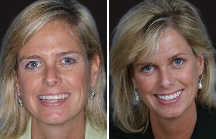 Collage of before and after cosmetic dental treatment photo