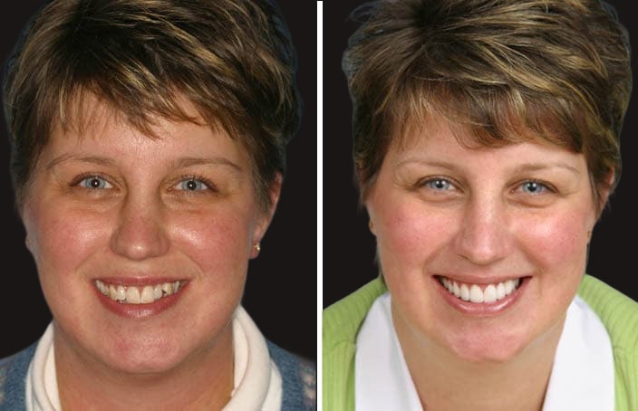 Collage of before and after cosmetic dental treatment photo