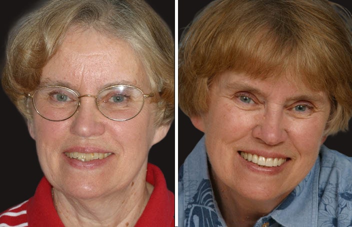 Collage of before and after cosmetic dental treatment photo