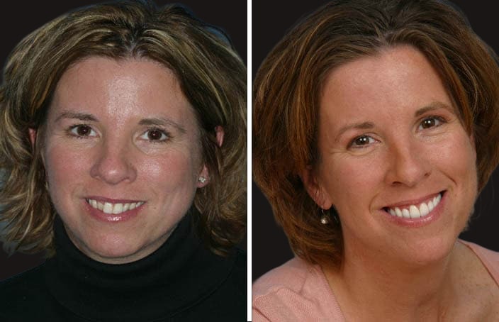 Collage of before and after cosmetic dental treatment photo