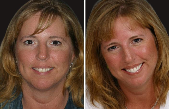 Collage of before and after cosmetic dental treatment photo