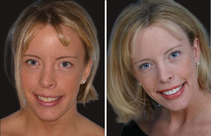 Collage of before and after cosmetic dental treatment photo