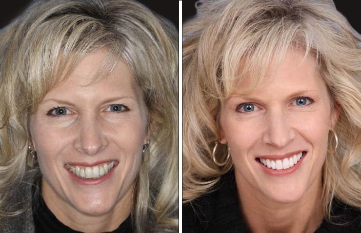 Collage of before and after cosmetic dental treatment photo
