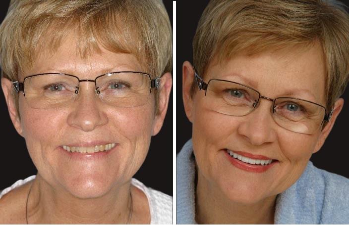 Collage of before and after cosmetic dental treatment photo