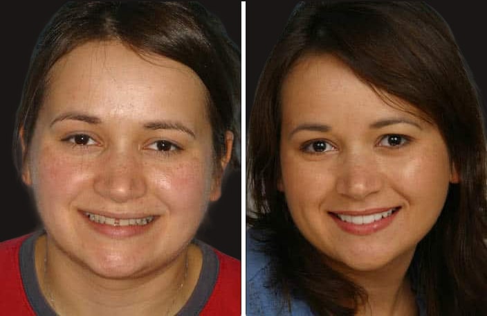 Collage of before and after cosmetic dental treatment photo